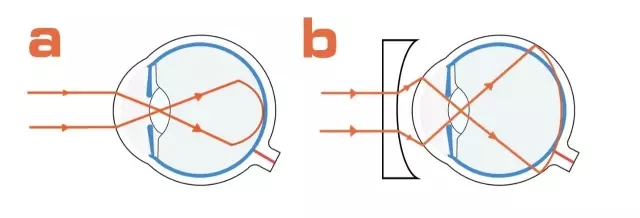 的(双方父母近视) 导致物象不能汇聚在视网膜上 可以利用凹透镜的原理