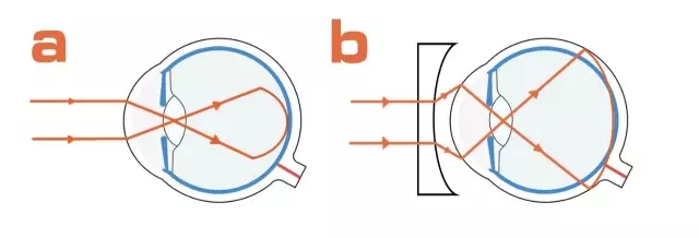这样就可以让视力得到矫正了把物像的焦点往后移可以利用凹透镜的原理