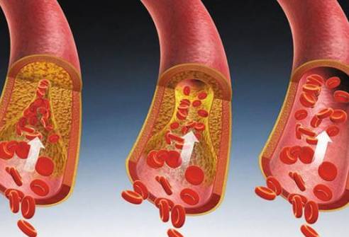 血管斑块变大,从30岁以后就加速了
