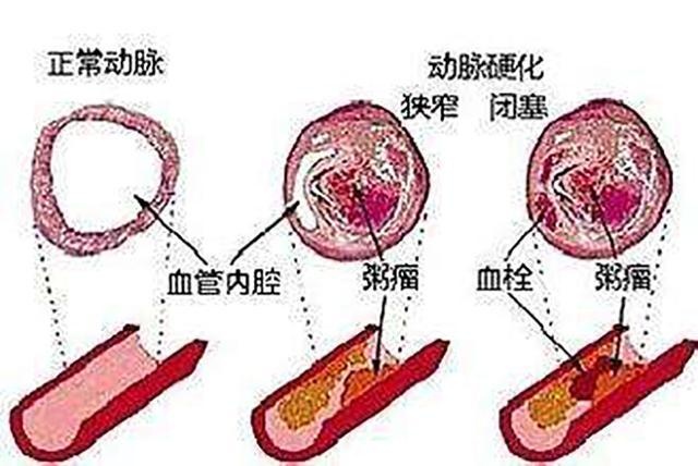 较易沉积在血管内壁形成斑块,从而造成动脉硬化狭窄