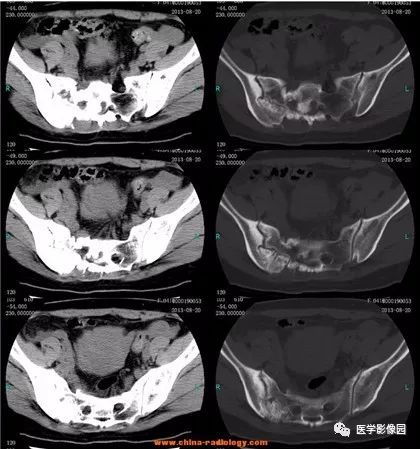 骶骨肿瘤,等你分析丨读片专栏622期