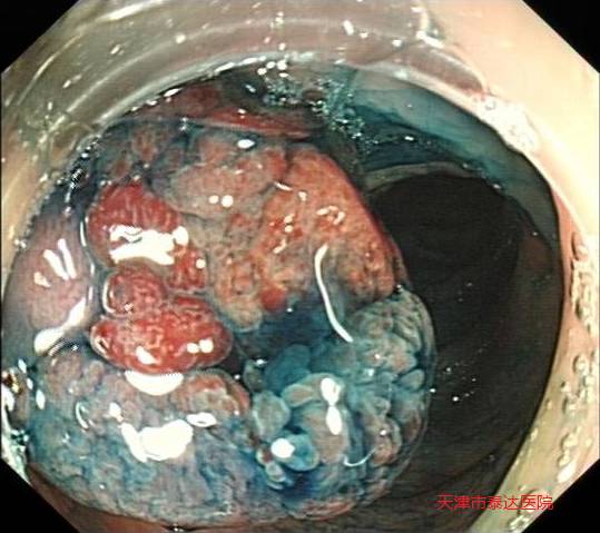 内镜下完整切除癌变结肠腺瘤一例