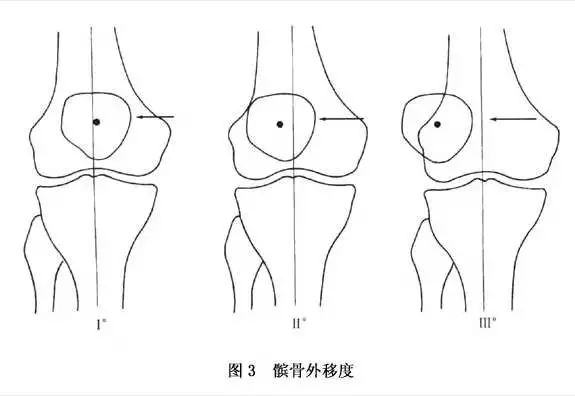 可向外侧移动的程度分为3度: Ⅰ度:髌骨中心在下肢轴线的内侧或轴线上