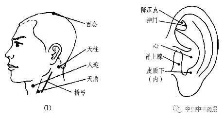 有效穴位百会,天柱,人迎,天鼎,桥弓等,及降压点,神门,心,肾上腺,皮质