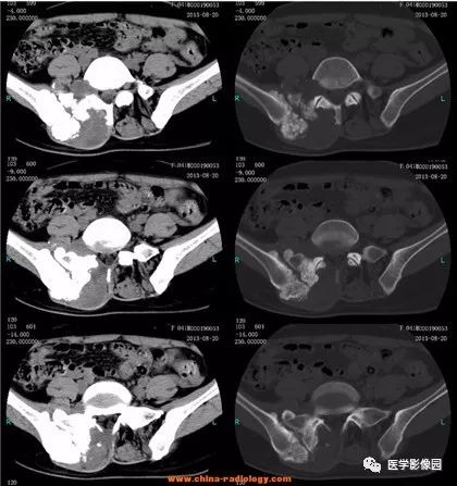 骶骨肿瘤,等你分析丨读片专栏622期