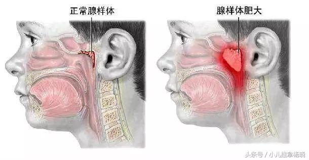 济南承康小儿推拿杨晓老师介绍小儿腺样体肥大的主要危害及小儿推拿