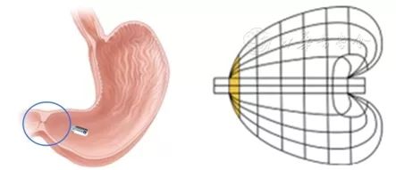 磁控胶囊胃镜观察幽门示意图