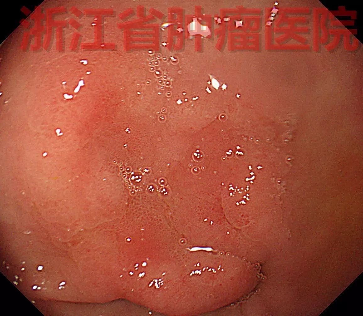 2016年9月30日查胃镜提示胃窦前壁见一黏膜凹陷,周边粘膜充血水肿