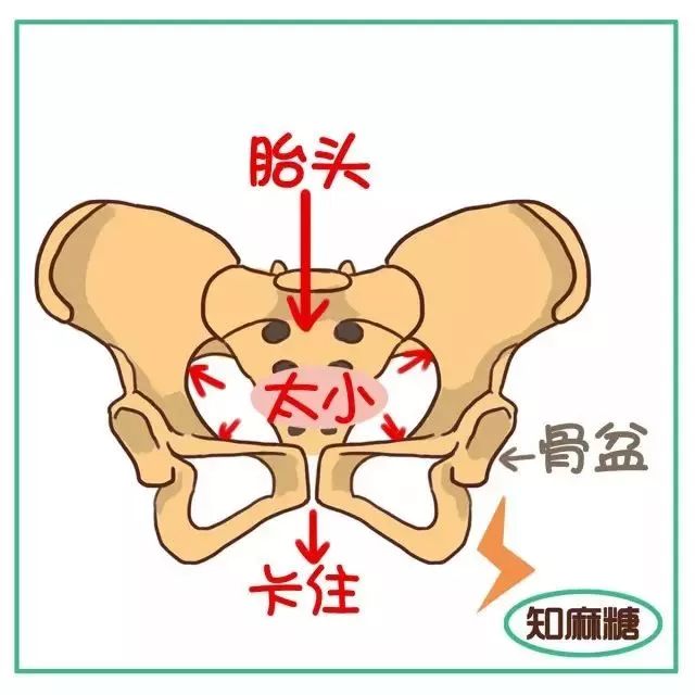 产道异常骨盆狭窄,阴道有横隔,或有较大肿瘤等2.