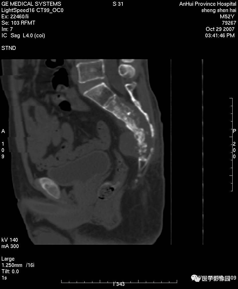 ct平扫显示骶骨正中呈溶骨性膨胀性骨质破坏区,形态欠规整,有较大的软