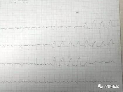 病人的心电图结果,"红旗飘飘"为典型的急性心梗