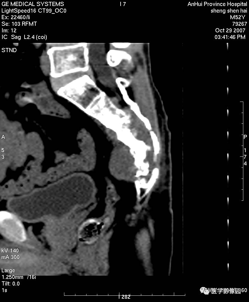 ct平扫显示骶骨正中呈溶骨性 膨胀性骨质破坏区, 形态欠规整, 有较大