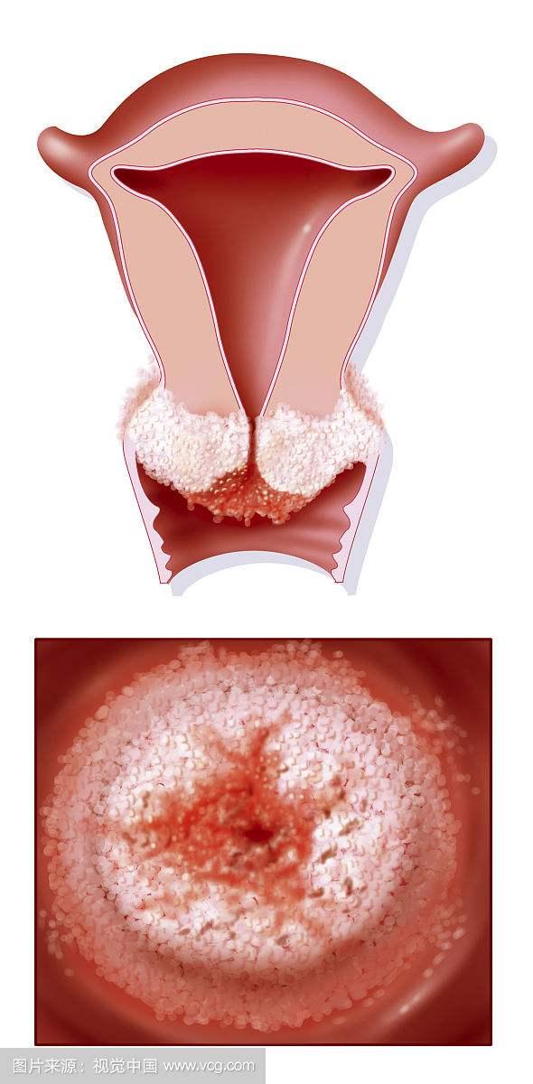 宫颈癌的早期症状有哪些预防宫颈癌吃什么食物好