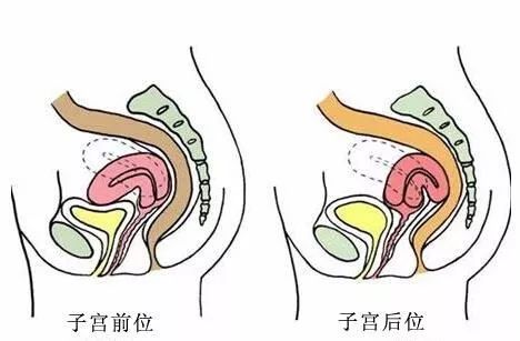 子宫前位或后位和怀孕有什么关系?