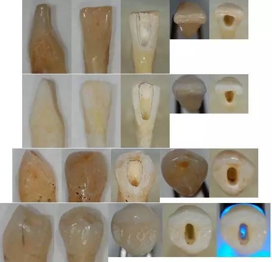 牙医必须掌握各牙齿的开髓形态