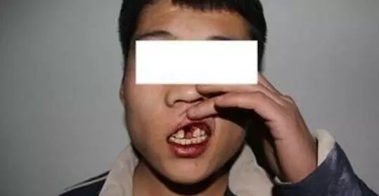 萍乡一男人竟然酒后把保安的两颗牙齿打掉