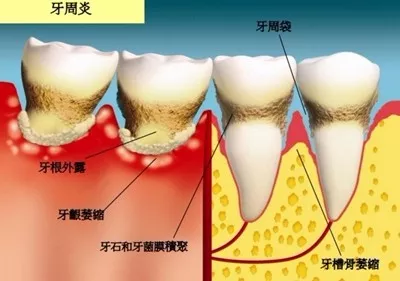 牙周病会导致牙根周围的牙槽骨吸收