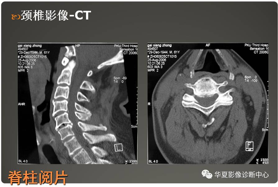 脊柱解剖及阅片基础