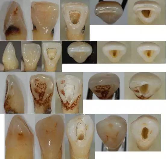 牙医必须掌握各牙齿的开髓形态