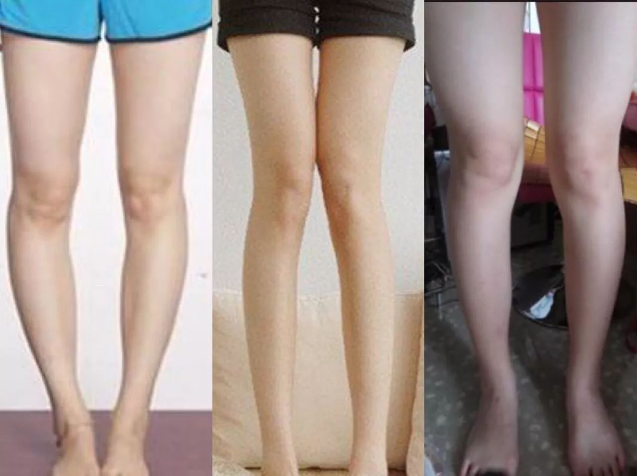 「女明星腿精大赏」o型腿是如何蜕变成美腿的？_小腿