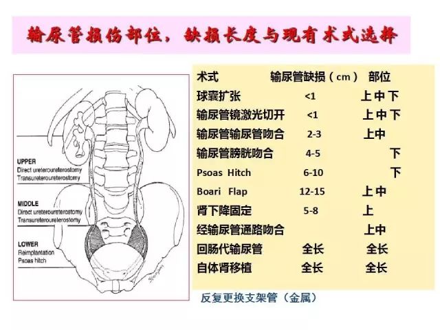 姜昊文|医源性输尿管狭窄的临床治疗与修复技术的创新探索