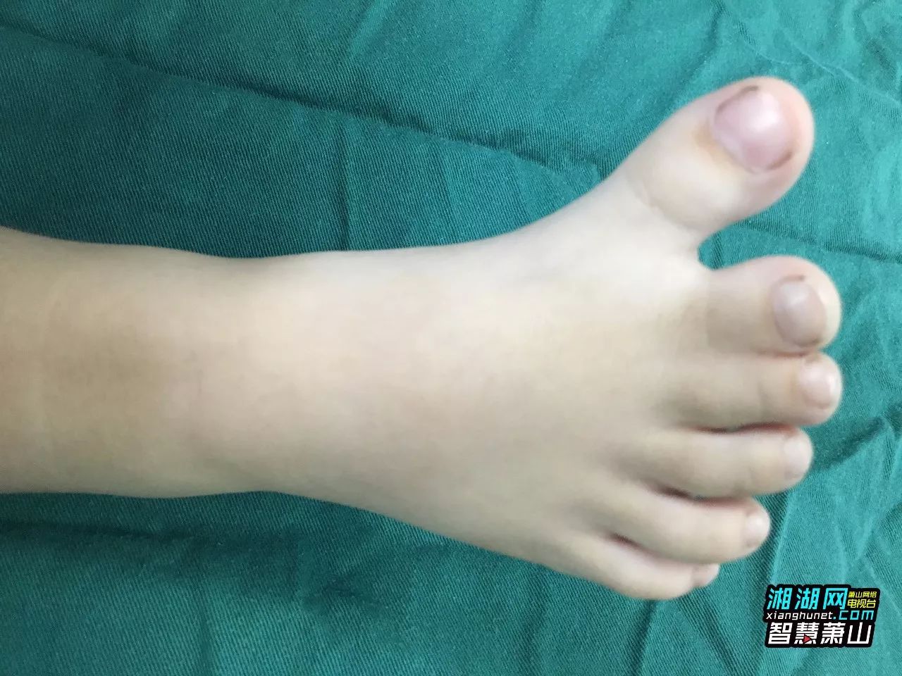 【资讯】萧山一3岁男孩有六个脚趾,中指和无名指被黏连!