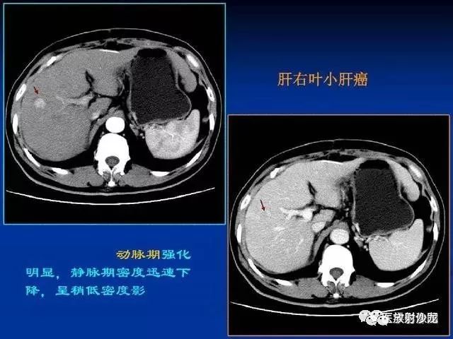 原发性肝癌的ct技术和诊断指南