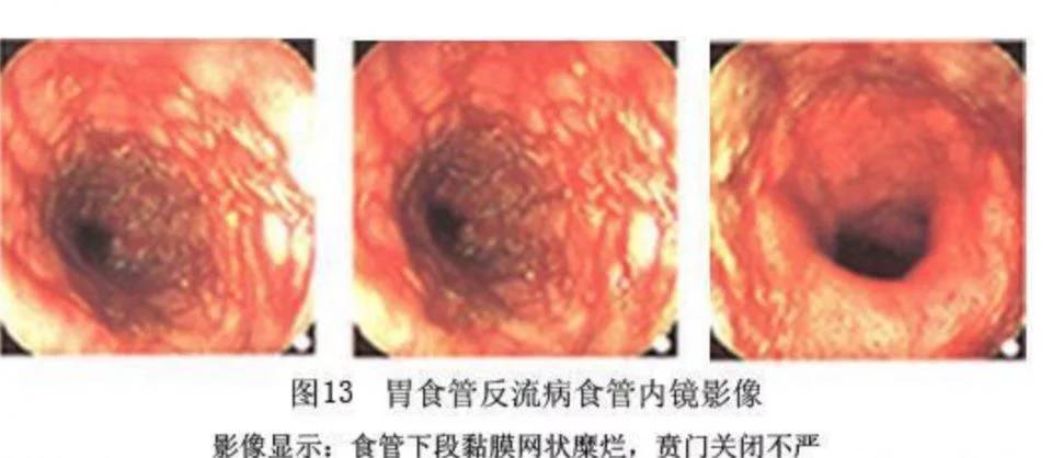 尿毒症病人口气臭_尿毒症病人图片(2)