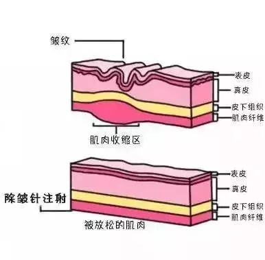 皱纹怎么办啊