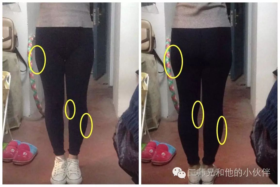 大腿肌肉外翻 小腿肌肉外翻:不直的线条比直线条显短