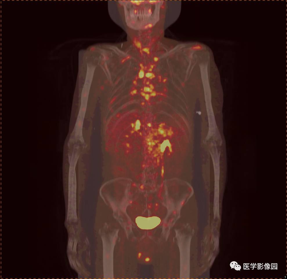 第八章骨骼与软组织第二节骨肿瘤四转移性骨肿瘤丨精品连载