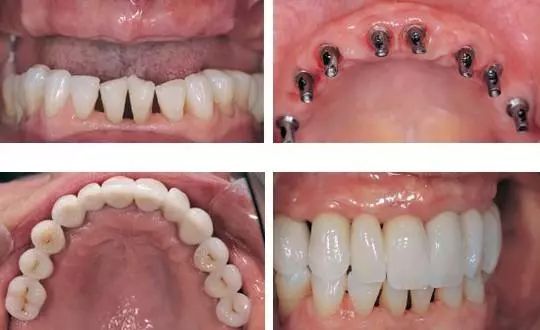 可以根据就诊者的脸型,其他牙齿的形状与颜色制作牙冠,达到整体协调