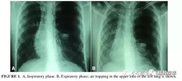 气胸为什么会被误诊?盘点那些被歪国人误诊的气胸.