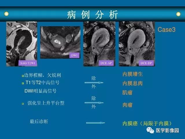 女性盆腔病变mri诊断思路丨影像天地