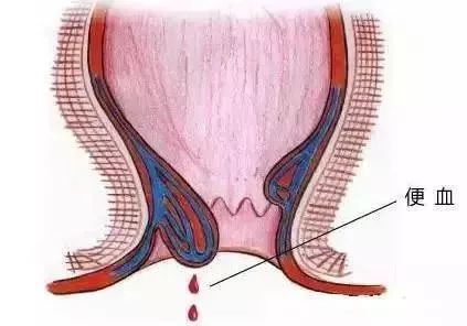 痔疮,肛裂等常见良性肛肠疾病因为病位的原因,通常呈现与大便不相混杂
