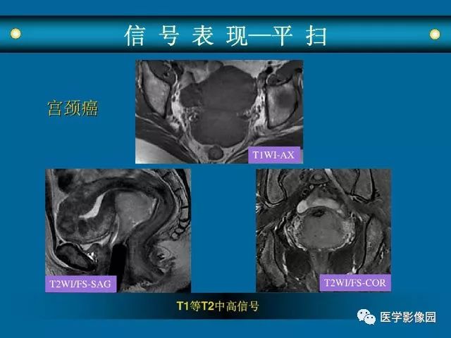 女性盆腔病变mri诊断思路丨影像天地