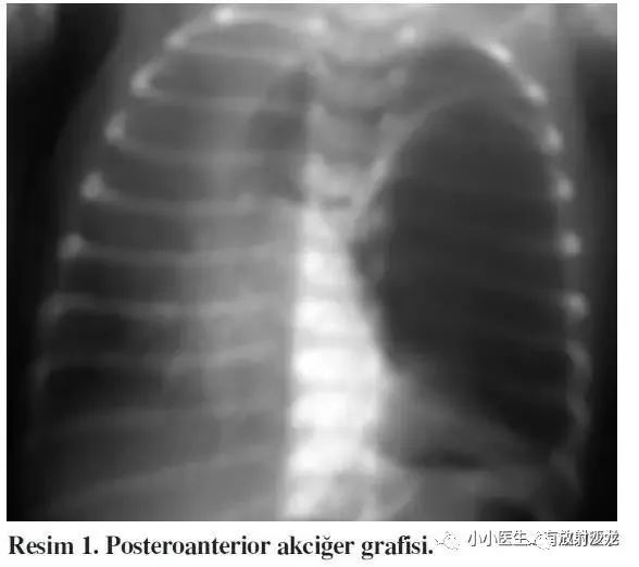 查体:呼吸78次/分,三凹征,气管向右侧移位.spo2 ,吸入空气下,70~80%.