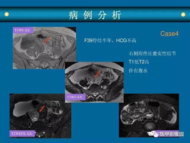 女性盆腔病变mri诊断思路丨影像天地