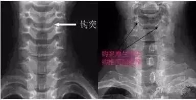 这样看颈椎x线你也能成为高手