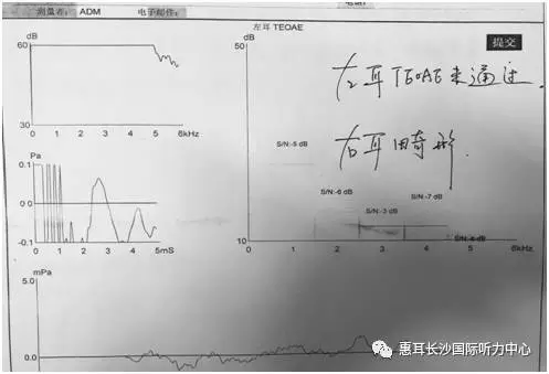 一侧耳廓外耳道正常但重度听力损失;随后完善了双耳的气导和骨导分频