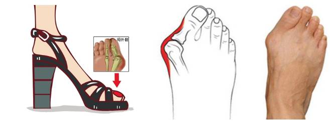 穿高跟鞋鞋跟歪怎么办