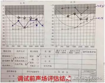 气导和骨导助听设备耦合同步干预经典案例