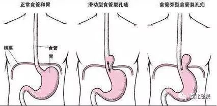 大妈食道裂开,胃跑进胸腔,竟是因为"趁热吃"?