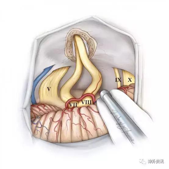 乙状窦后入路切除听神经瘤手术策略与技巧