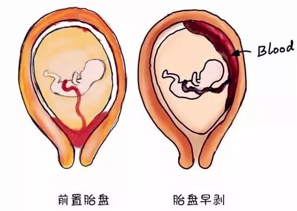 2,胎盘早剥出血的类型: 轻型:以显性出血为主,胎盘剥离面积一般不