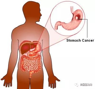 中国一半人口感染胃癌细菌_胃癌手术伤口感染病人