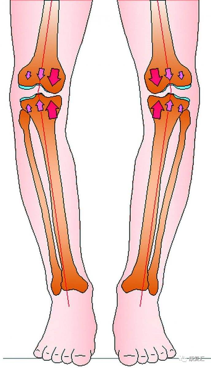 o型腿对健康影响 由于o型腿破坏了膝关节正常力的分布,使关节一侧所