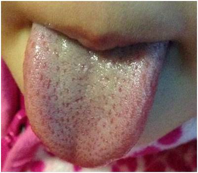 观舌知孩子健康