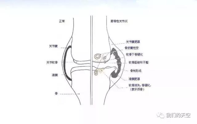 膝关节创伤性滑膜炎