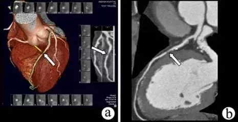 冠状动脉cta vs 冠状动脉造影 哪个好?